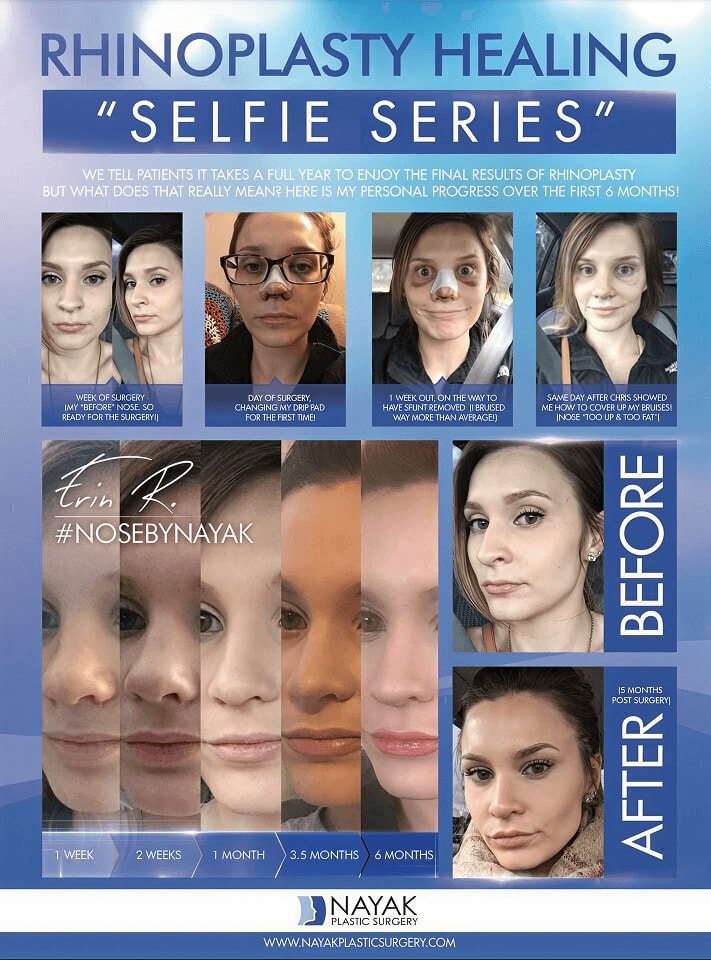 Rhinoplasty healing progress over six months.