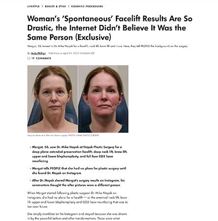 Before and after facelift results comparison.