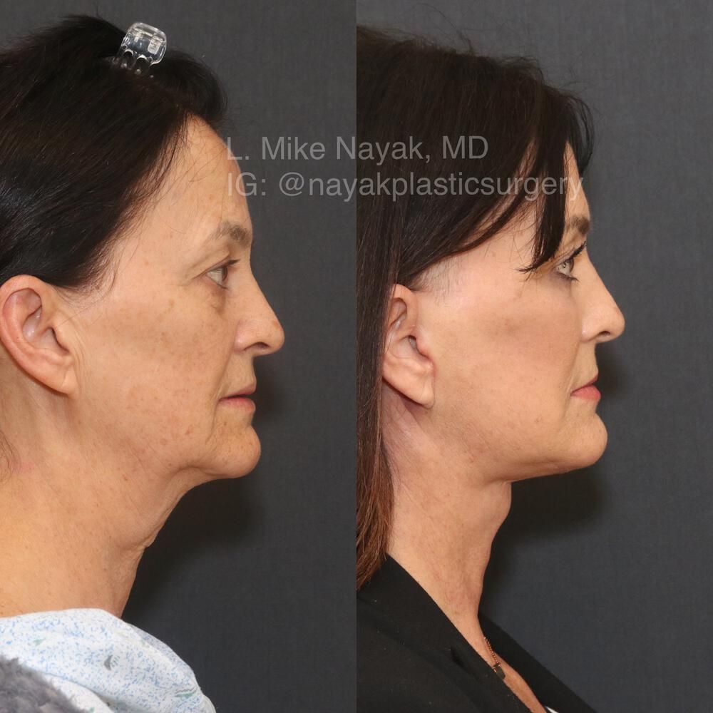 Facelift And Neck Lift Before & After