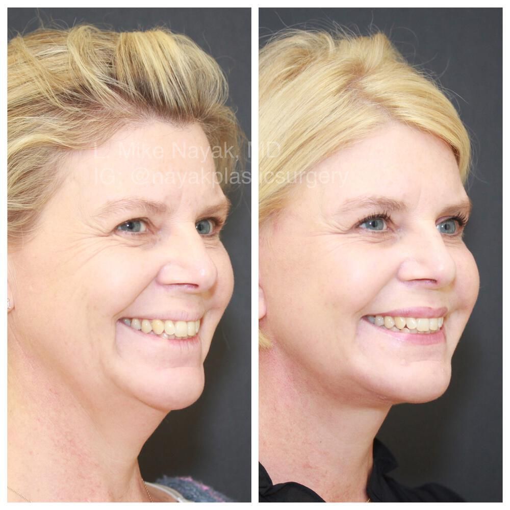 Facelift And Neck Lift Before & After