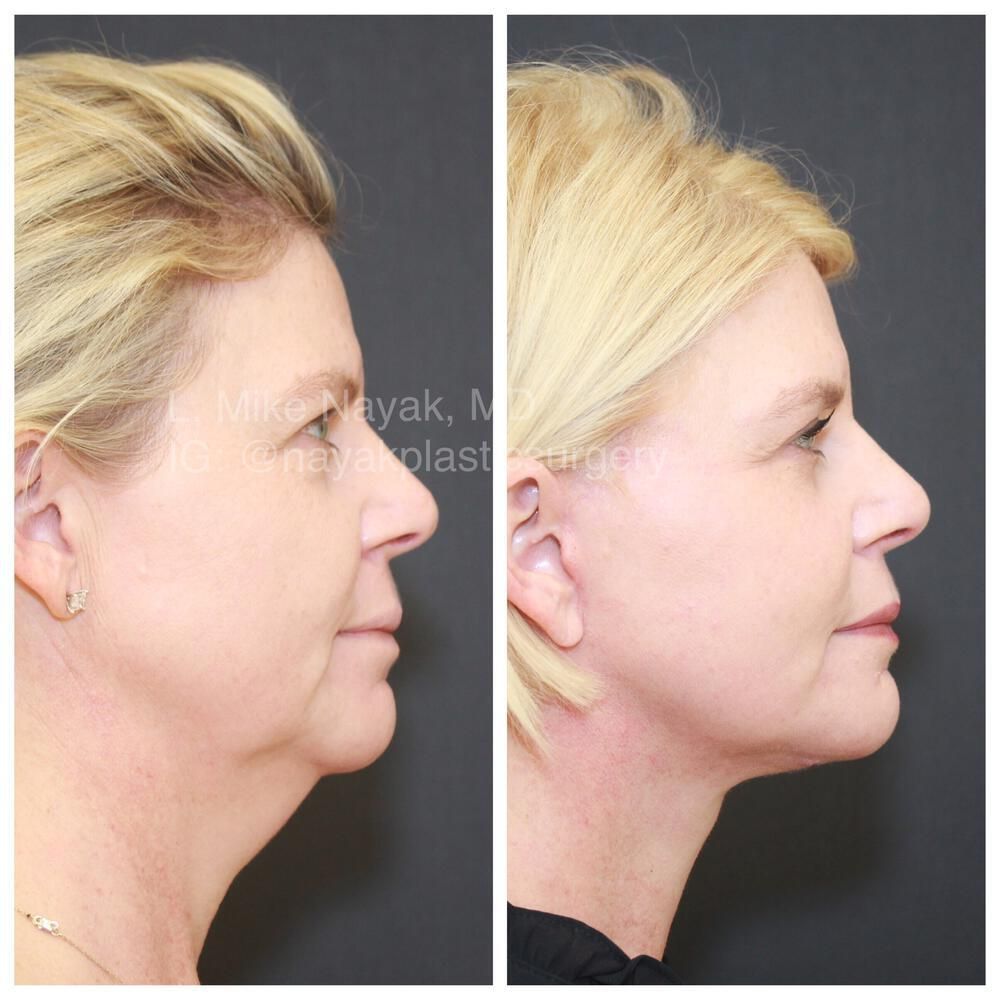 Facelift And Neck Lift Before & After