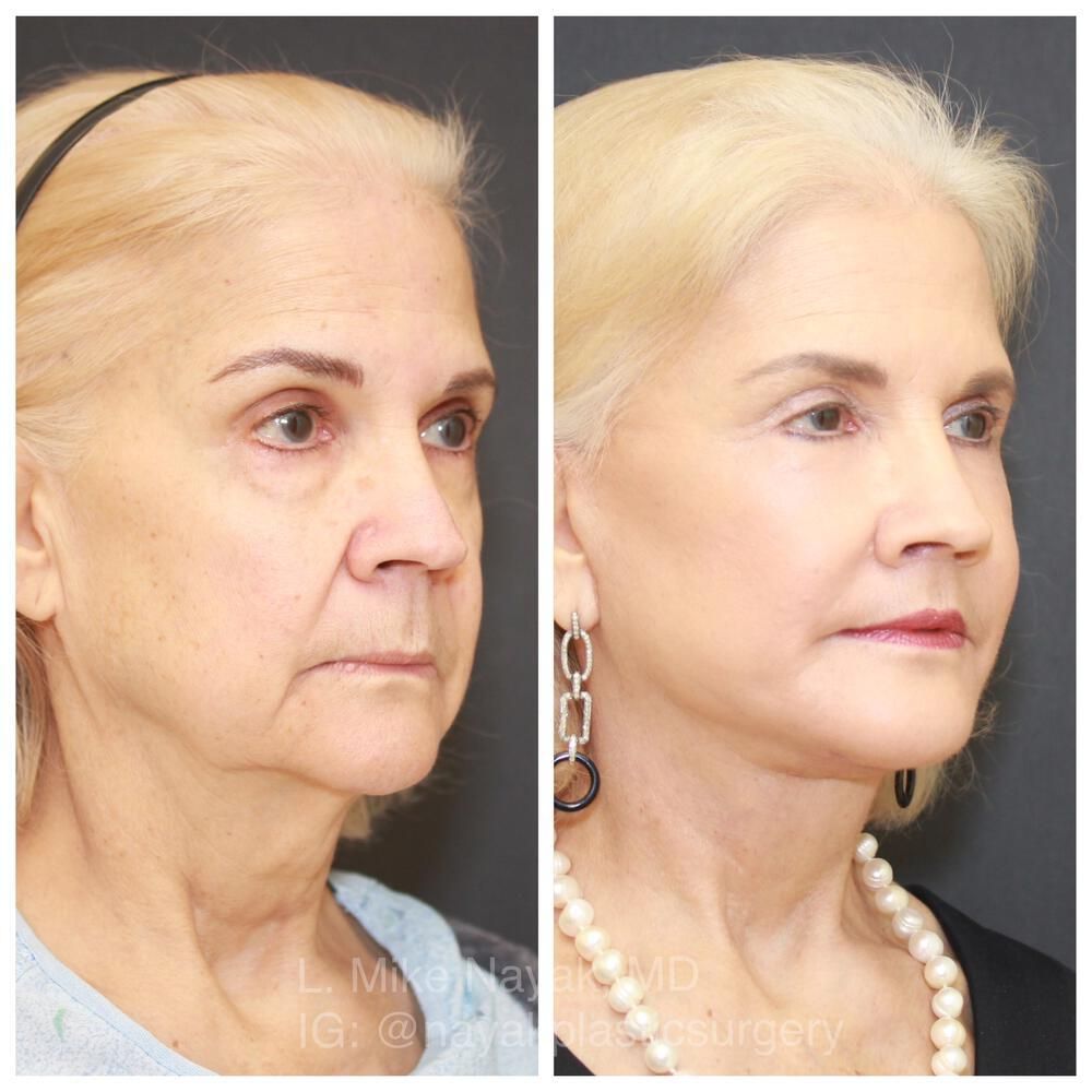 Facelift And Neck Lift Before & After