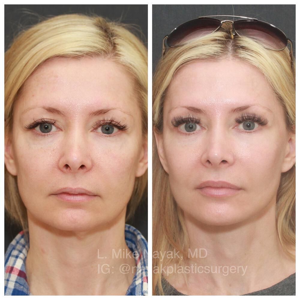 Facelift And Neck Lift Before & After