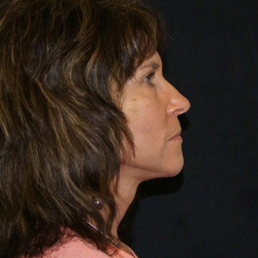 Facelift And Neck Lift Before & After