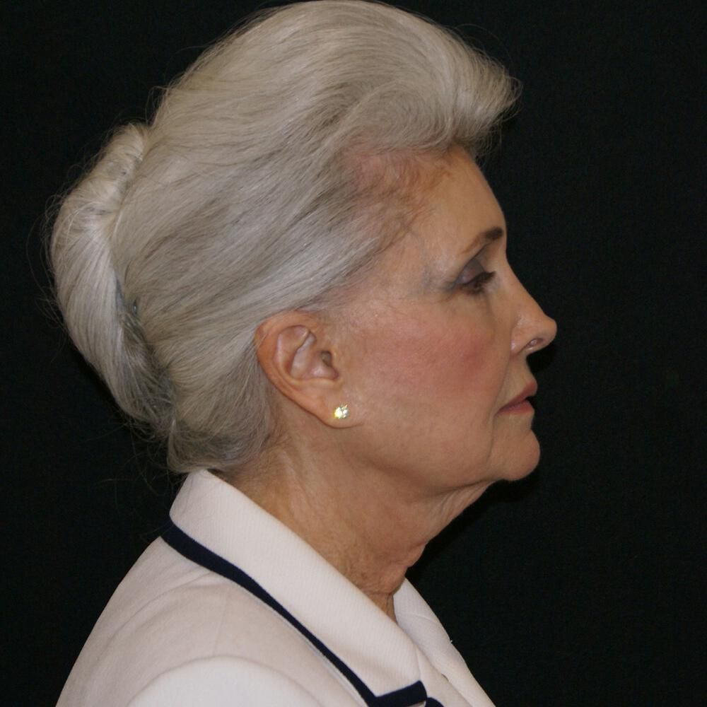 Facelift And Neck Lift Before & After