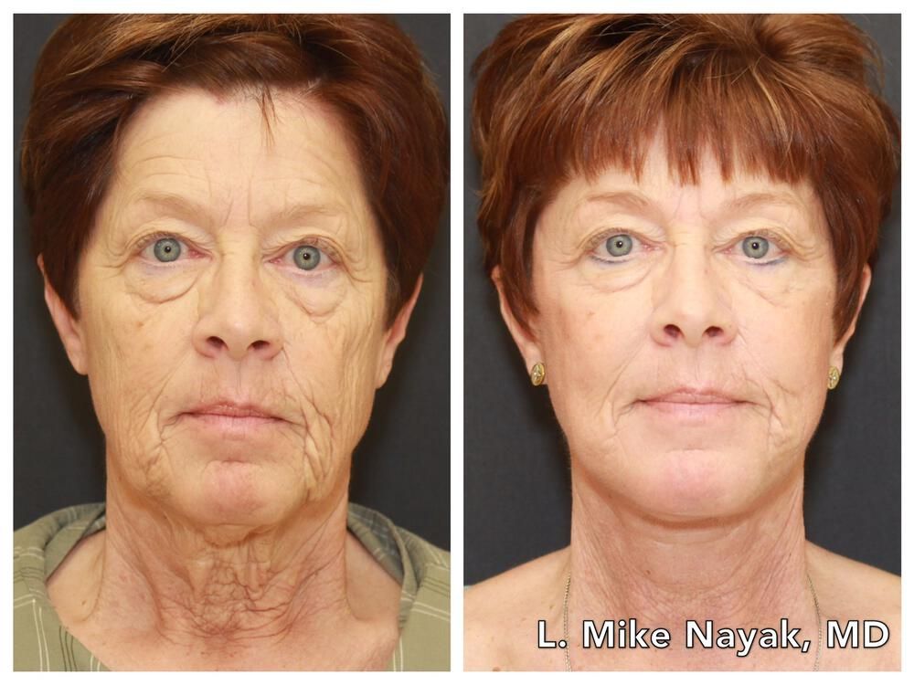 Facelift And Neck Lift Before & After