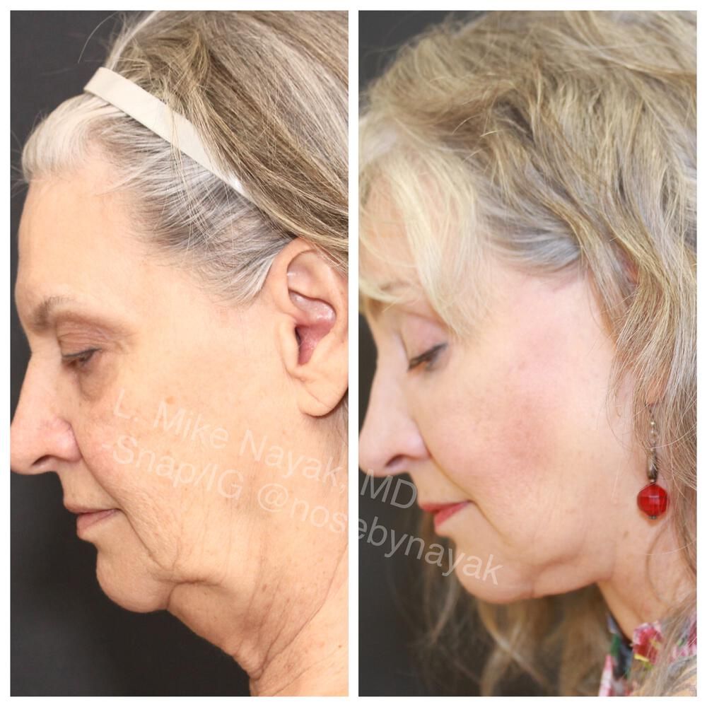Facelift And Neck Lift Before & After