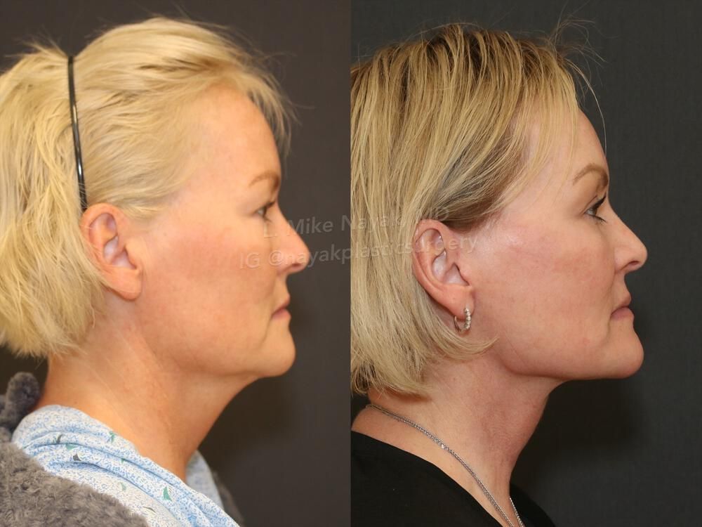 Facelift And Neck Lift Before & After