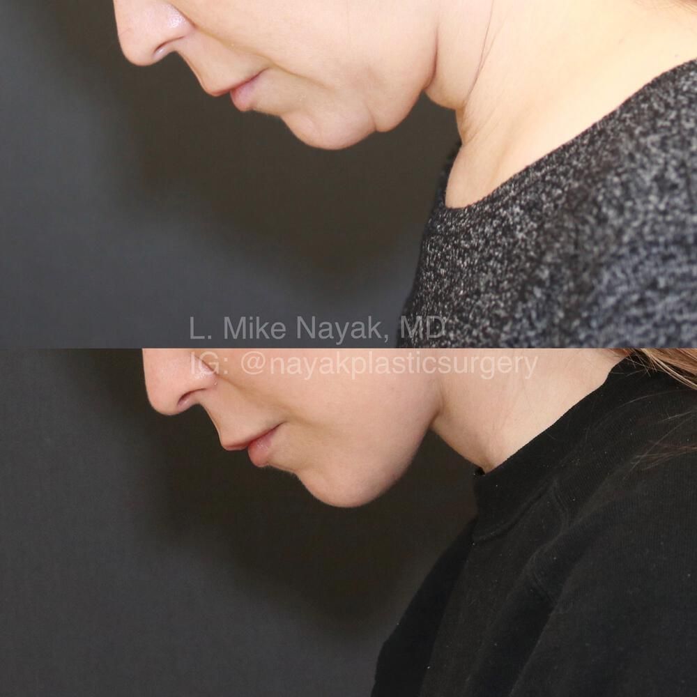 Facelift And Neck Lift Before & After