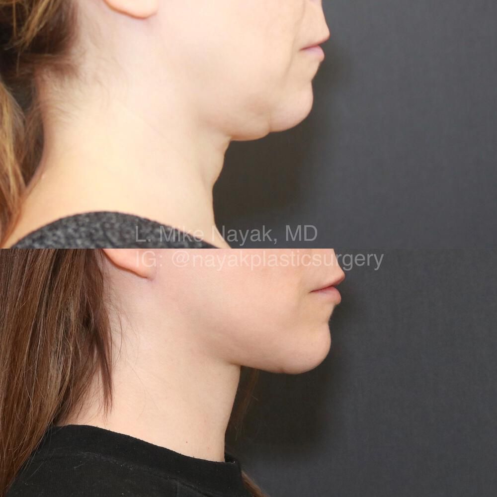 Facelift And Neck Lift Before & After