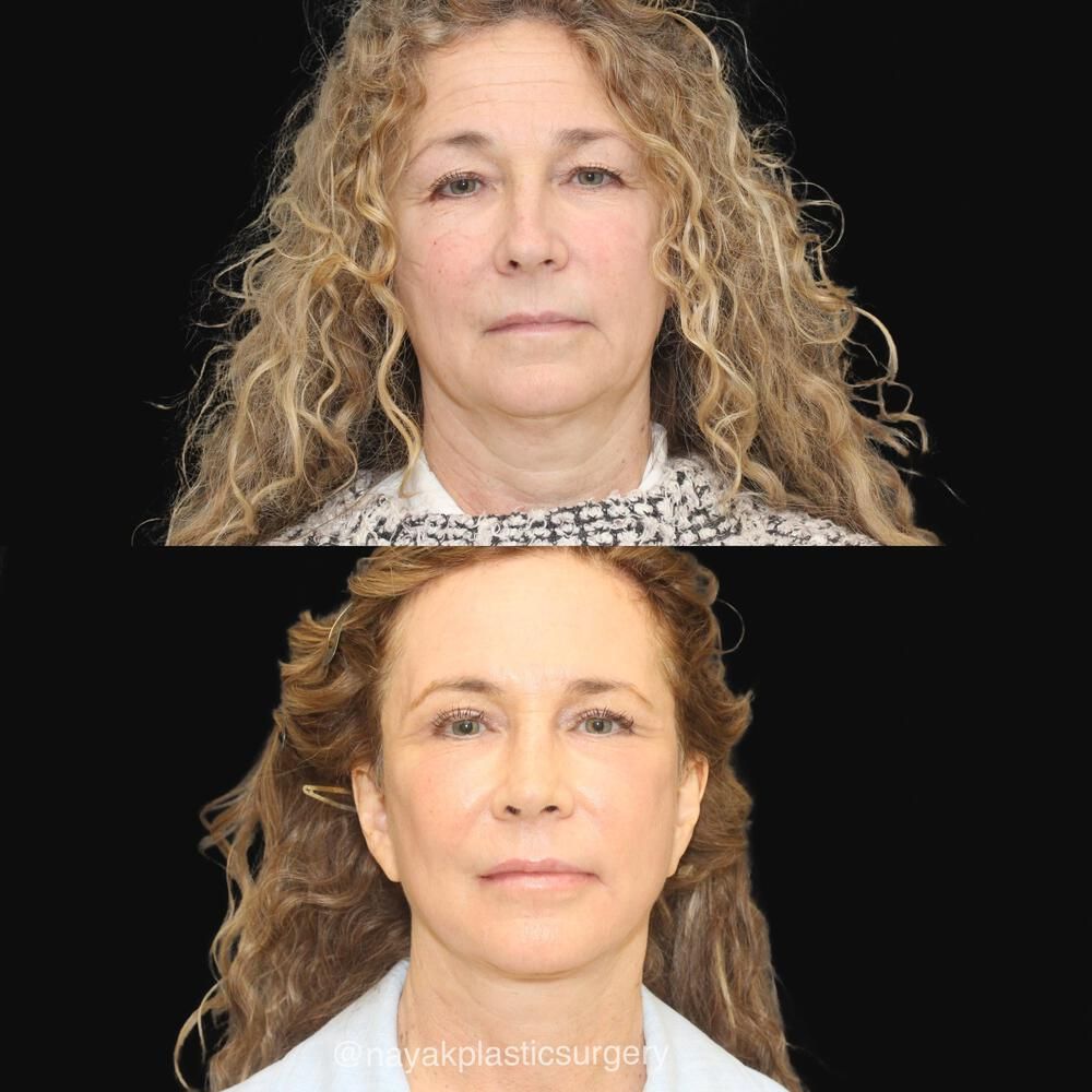 Facelift And Neck Lift Before & After