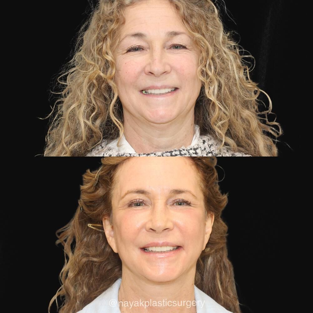 Facelift And Neck Lift Before & After