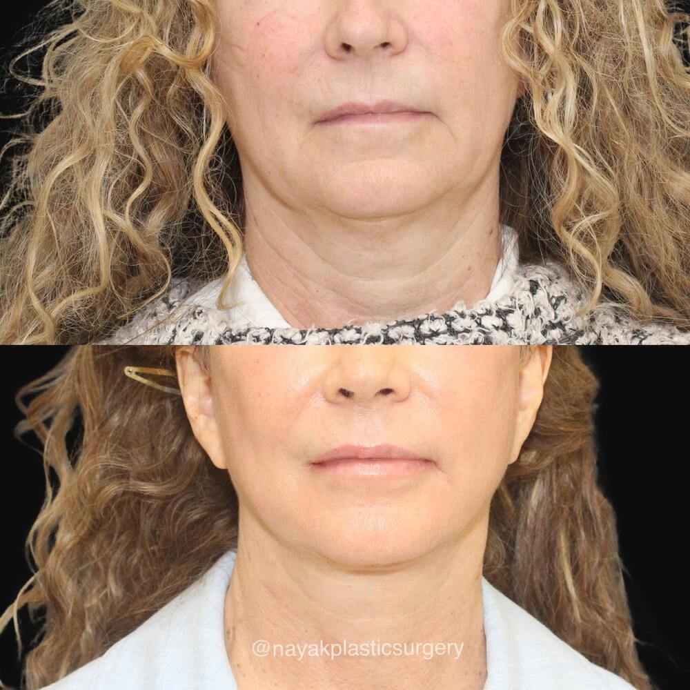 Facelift And Neck Lift Before & After