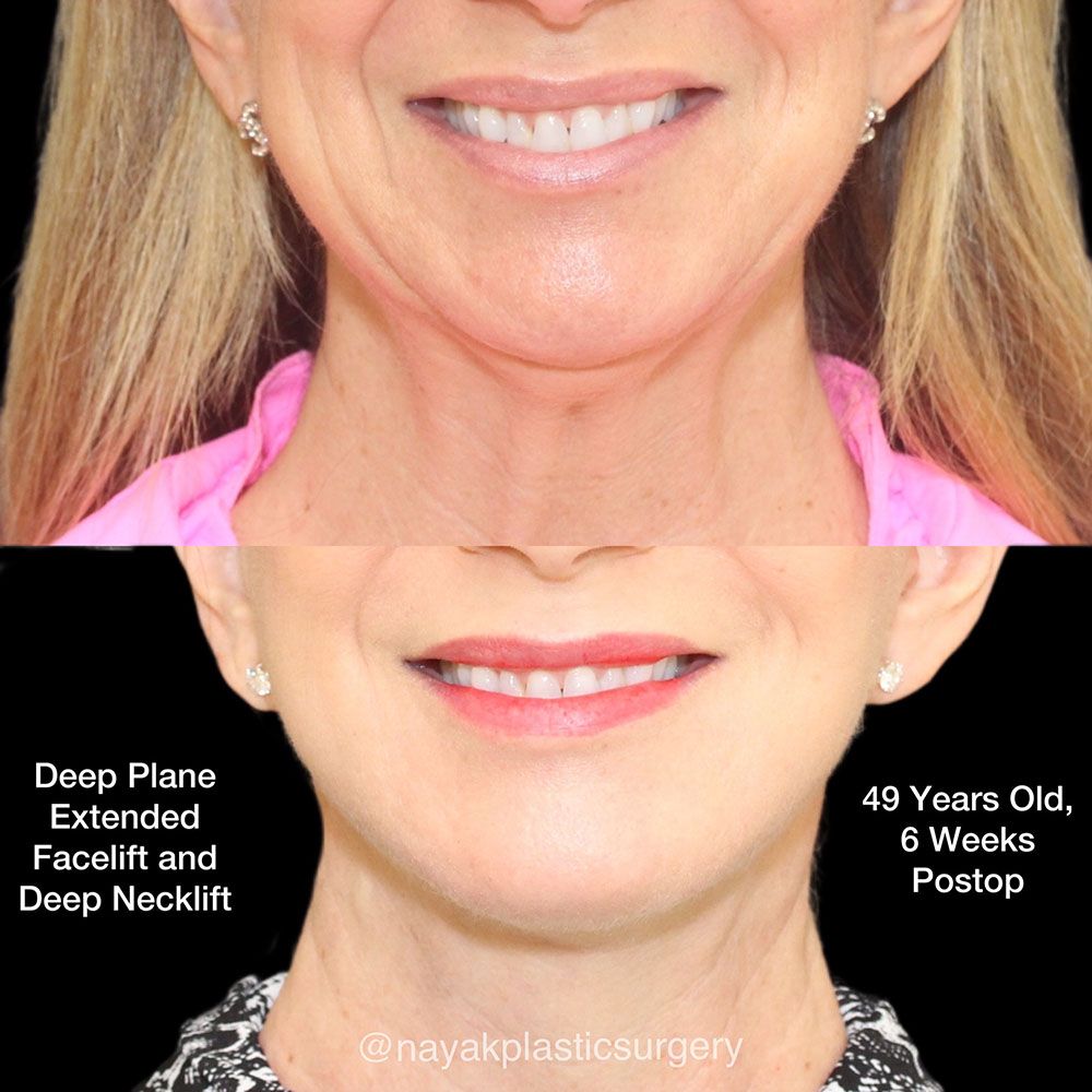 Facelift And Neck Lift Before & After
