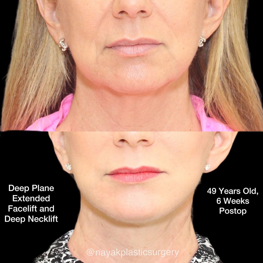 Facelift And Neck Lift Before & After