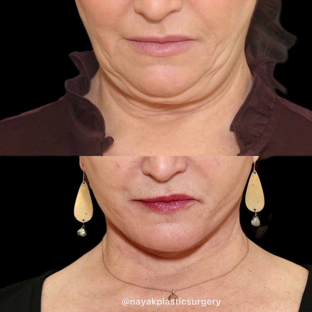 Facelift And Neck Lift Before & After