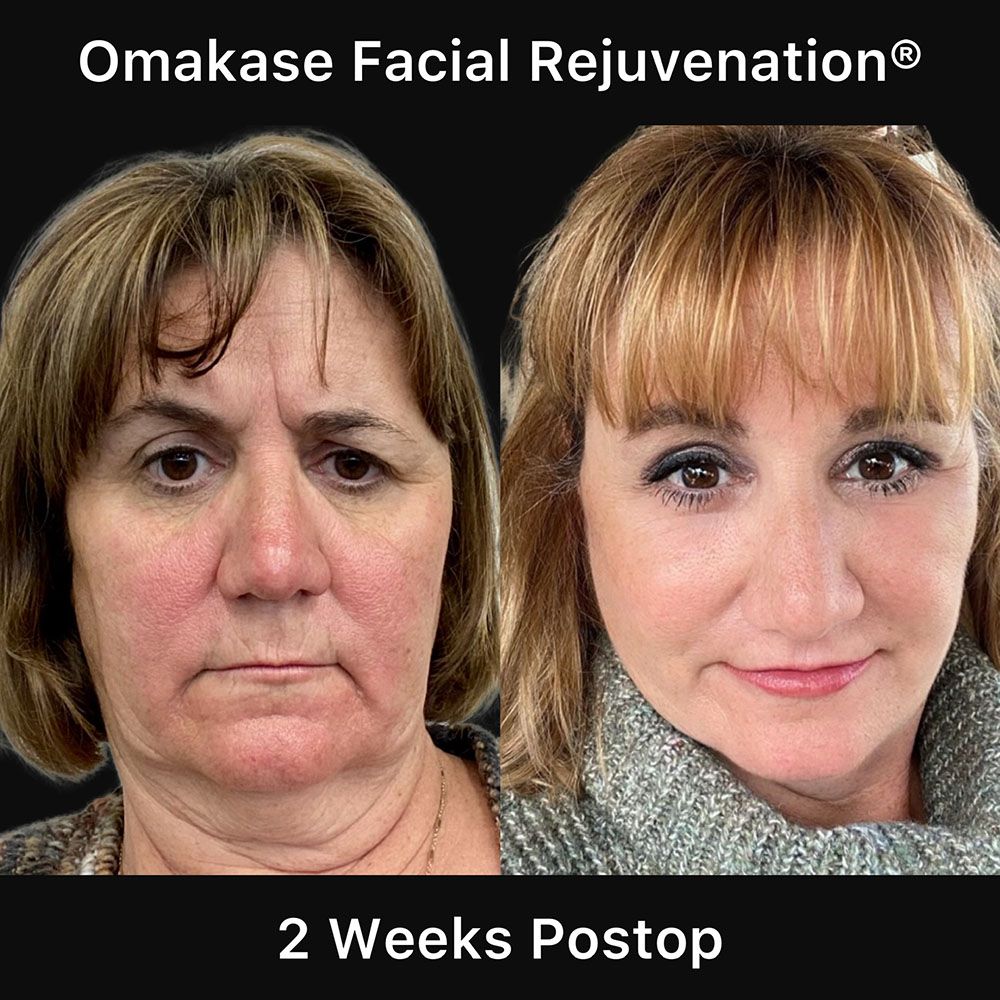 Facelift And Neck Lift Before & After