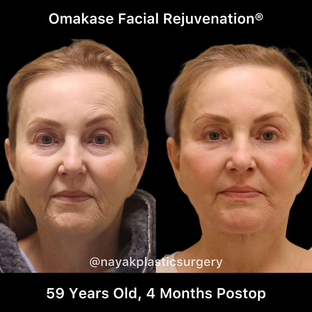 Facelift And Neck Lift Before & After