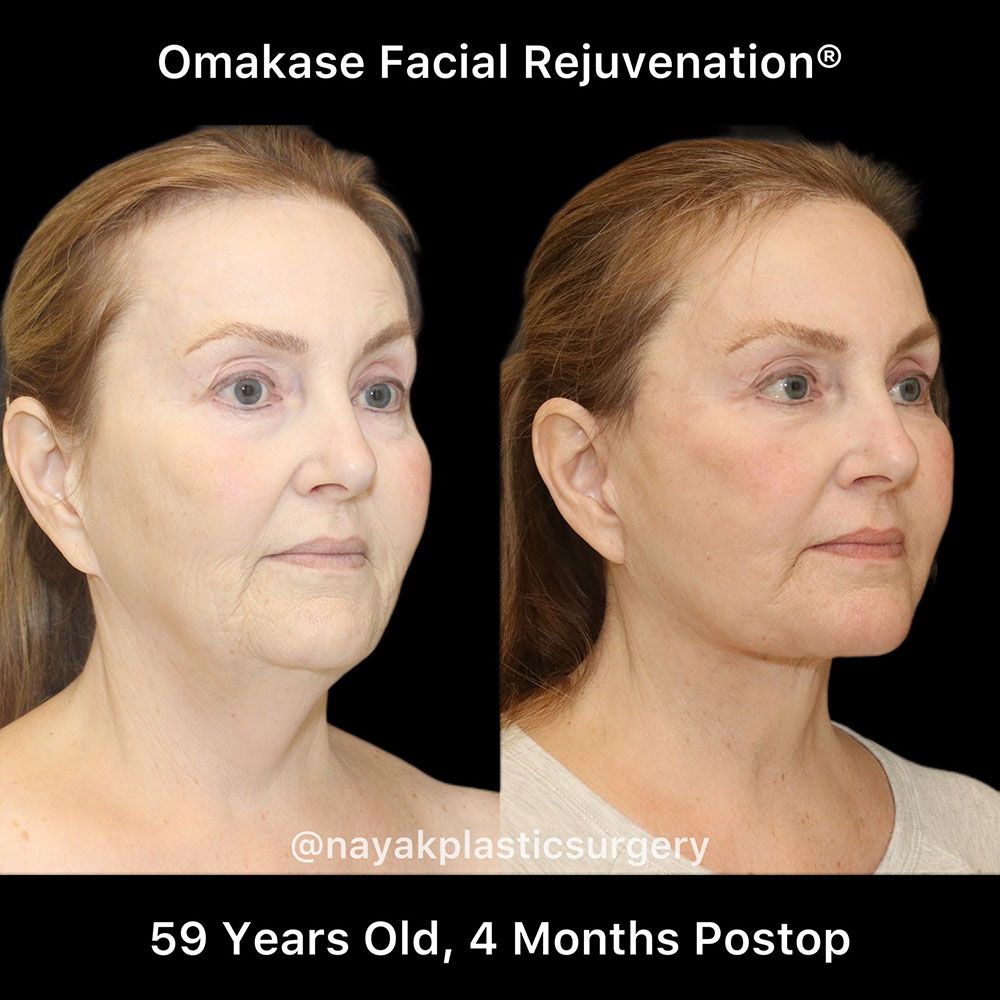 Facelift And Neck Lift Before & After