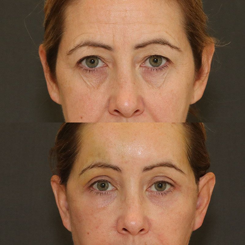 Facelift And Neck Lift Before & After
