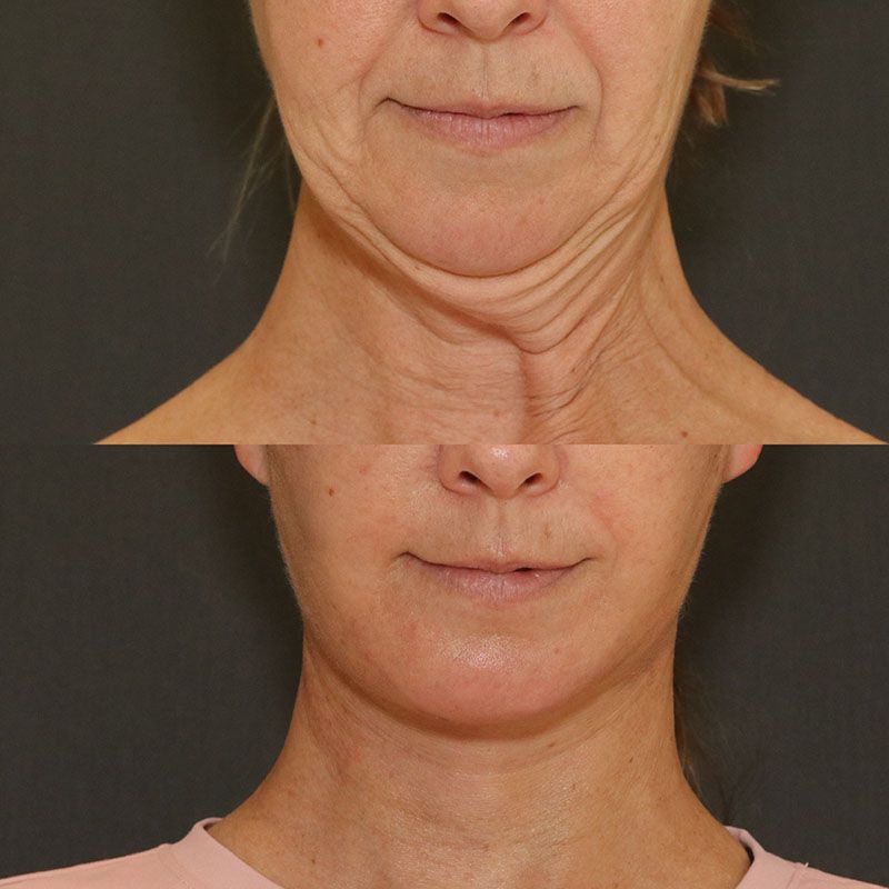 Facelift And Neck Lift Before & After