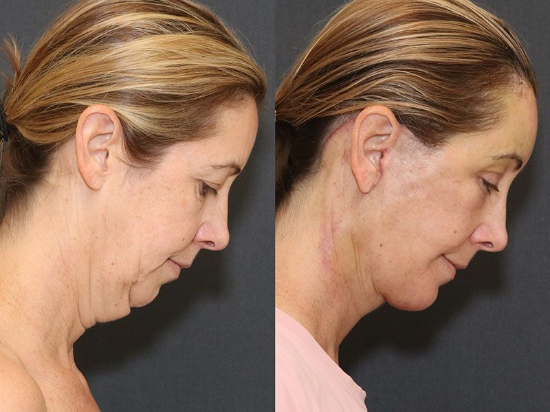 Facelift And Neck Lift Before & After