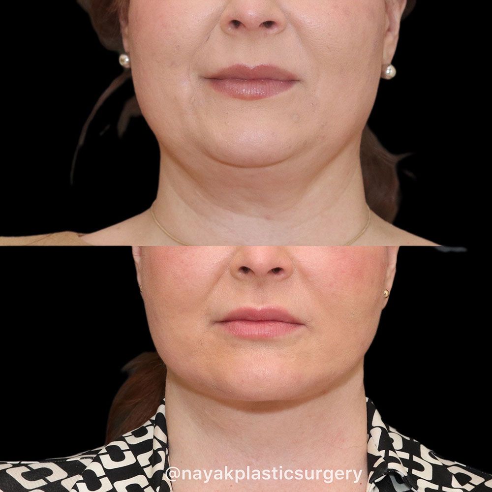 Facelift And Neck Lift Before & After