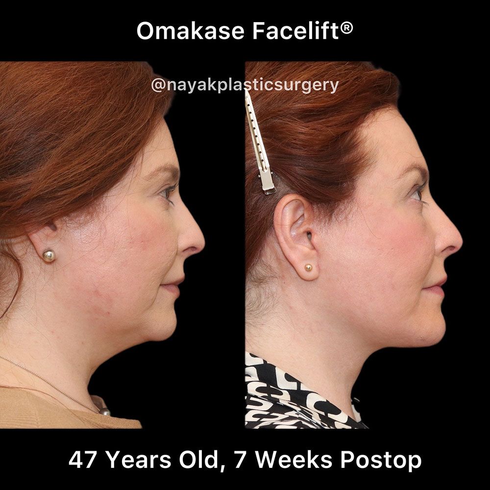 Facelift And Neck Lift Before & After