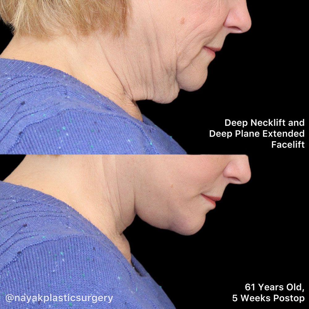 Facelift And Neck Lift Before & After