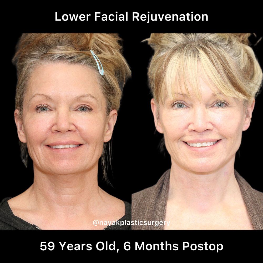 Facelift And Neck Lift Before & After