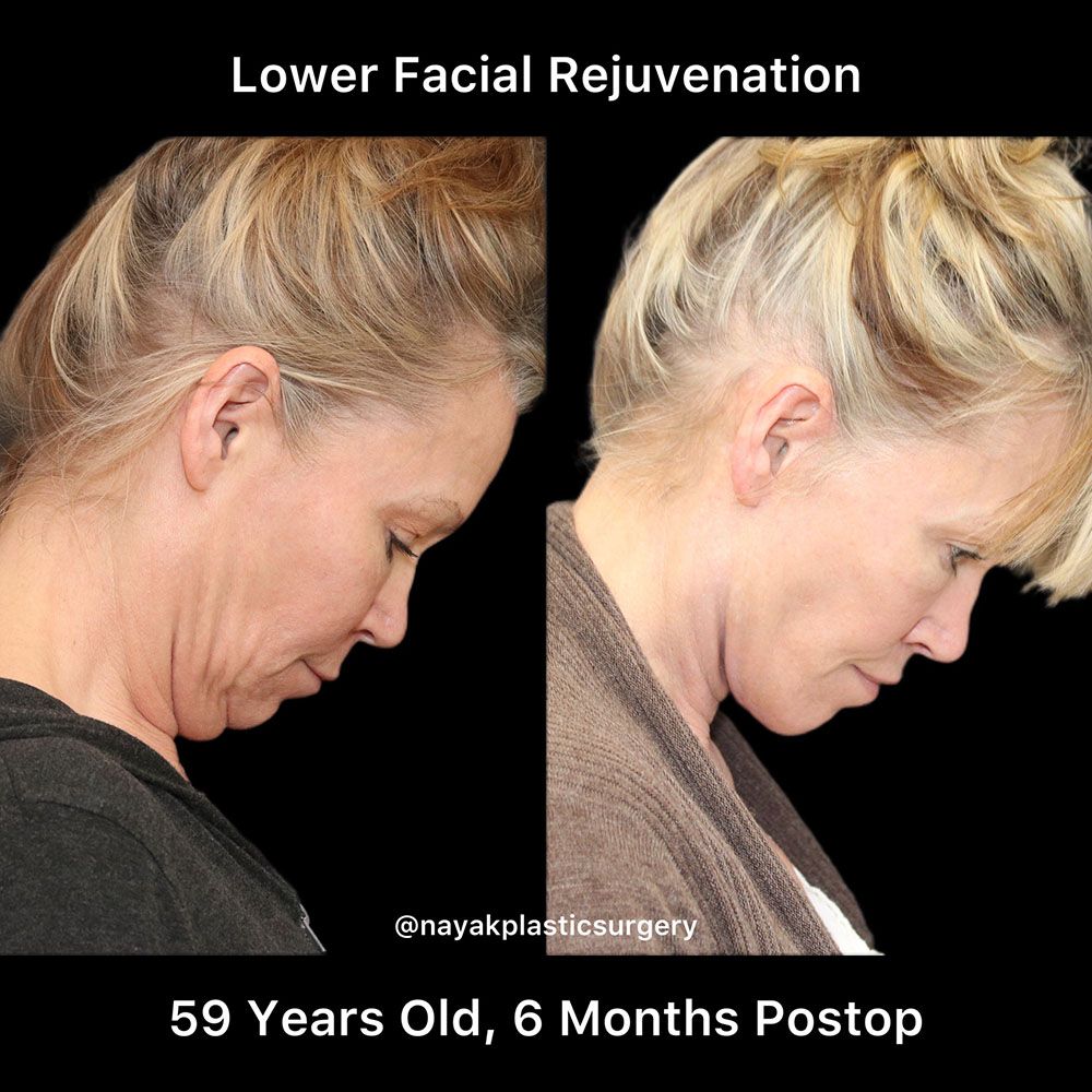 Facelift And Neck Lift Before & After