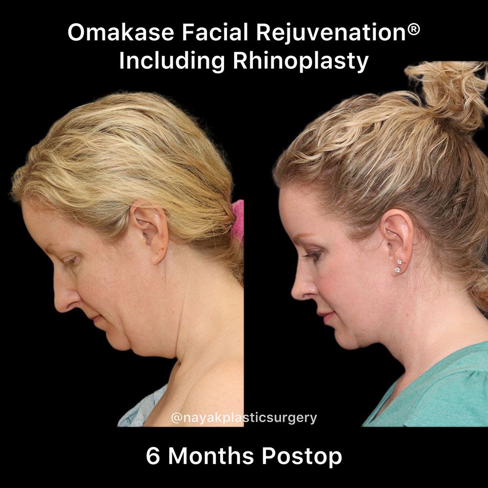 Facelift And Neck Lift Before & After