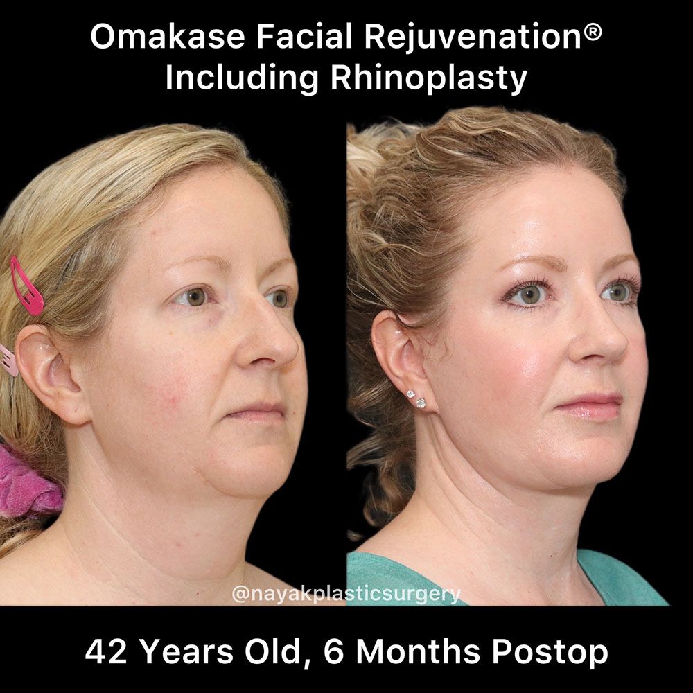 Facelift And Neck Lift Before & After
