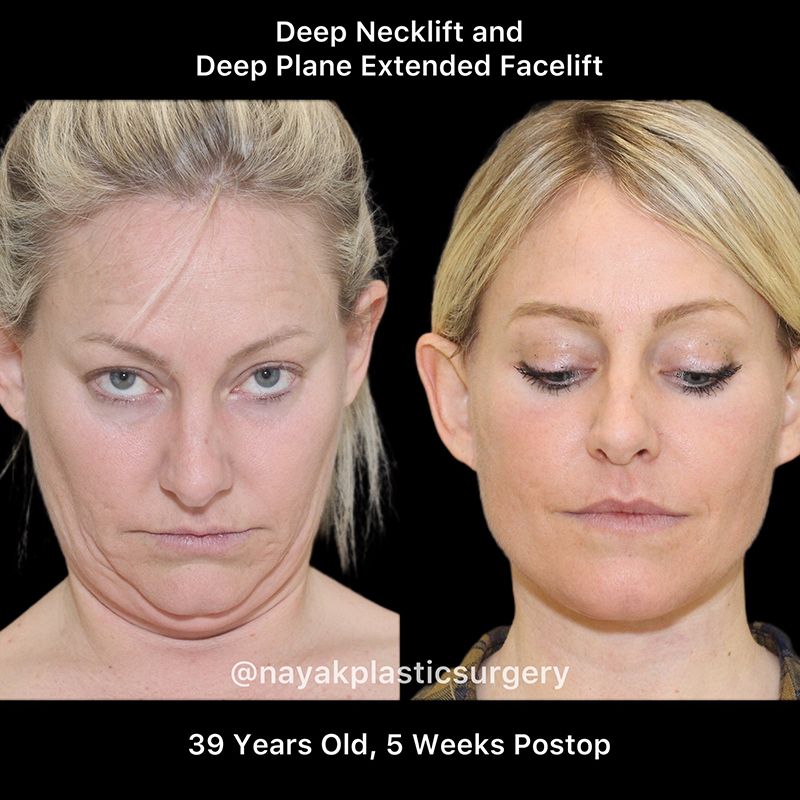 Facelift And Neck Lift Before & After
