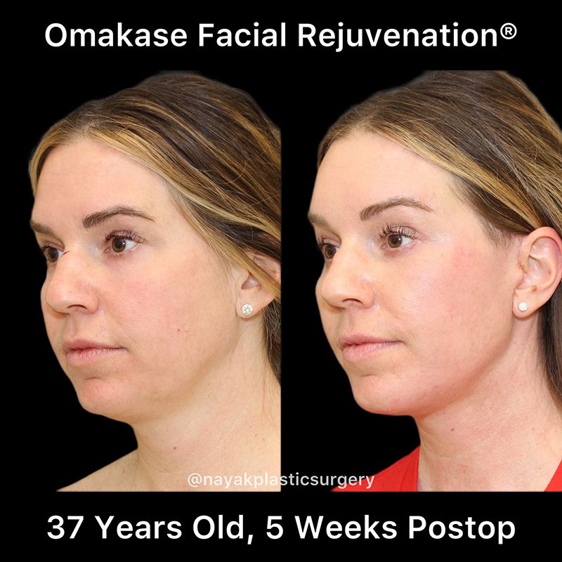 Facelift And Neck Lift Before & After