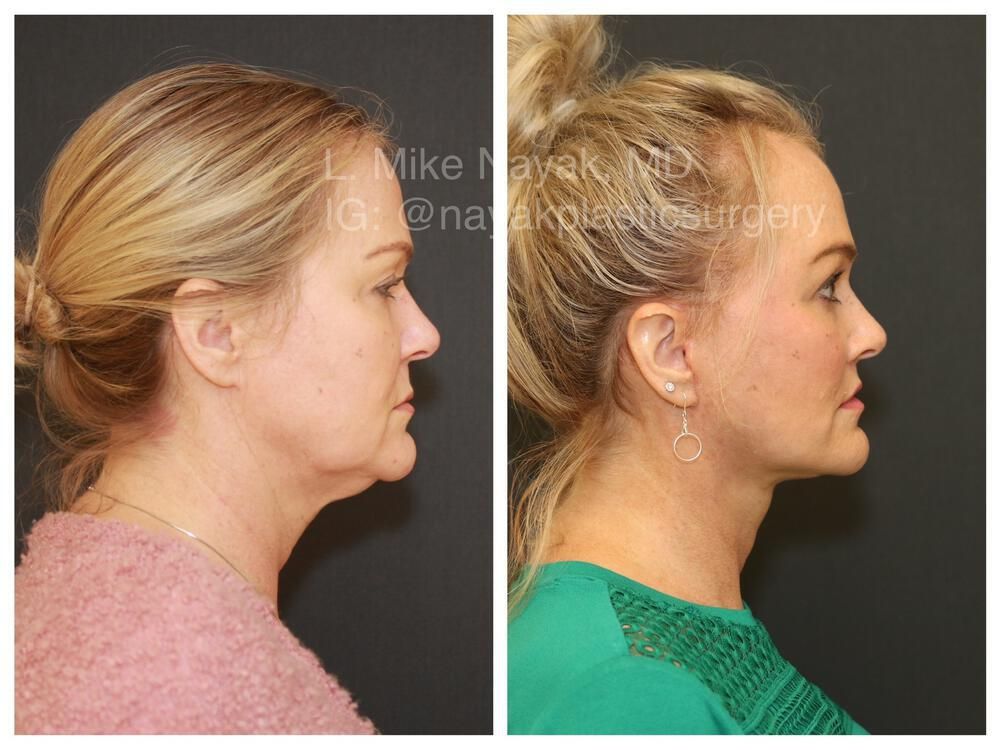 Brow Lift Before & After