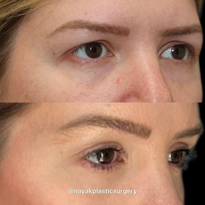 Brow Lift Before & After