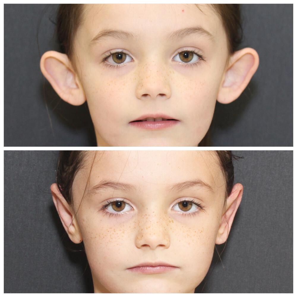 Ear Surgery Before & After