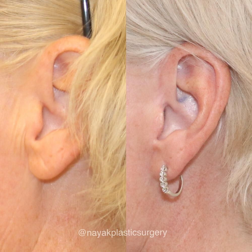 Ear Surgery Before & After