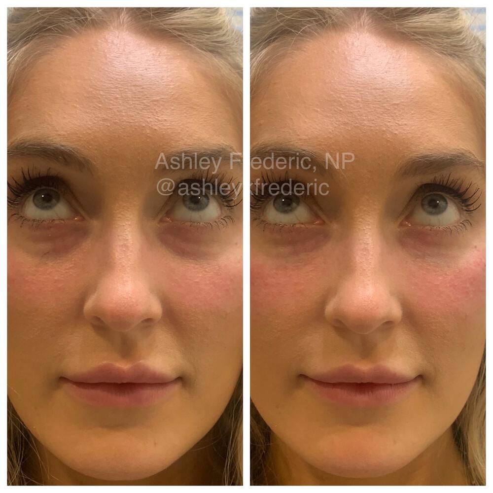 Tear Trough Filler Before & After