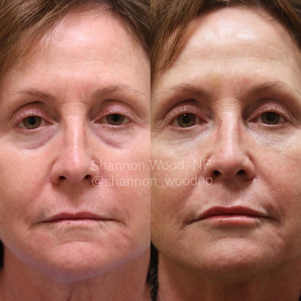 Tear Trough Filler Before & After