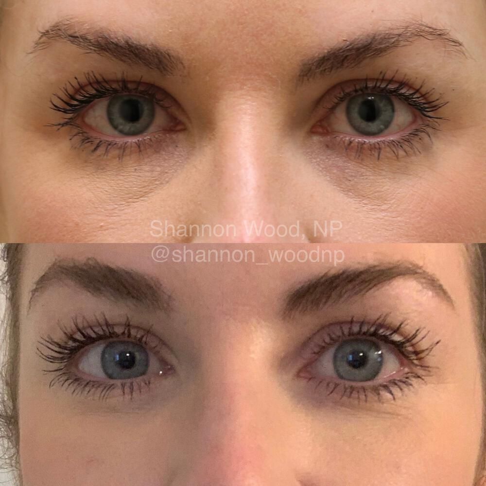 Tear Trough Filler Before & After