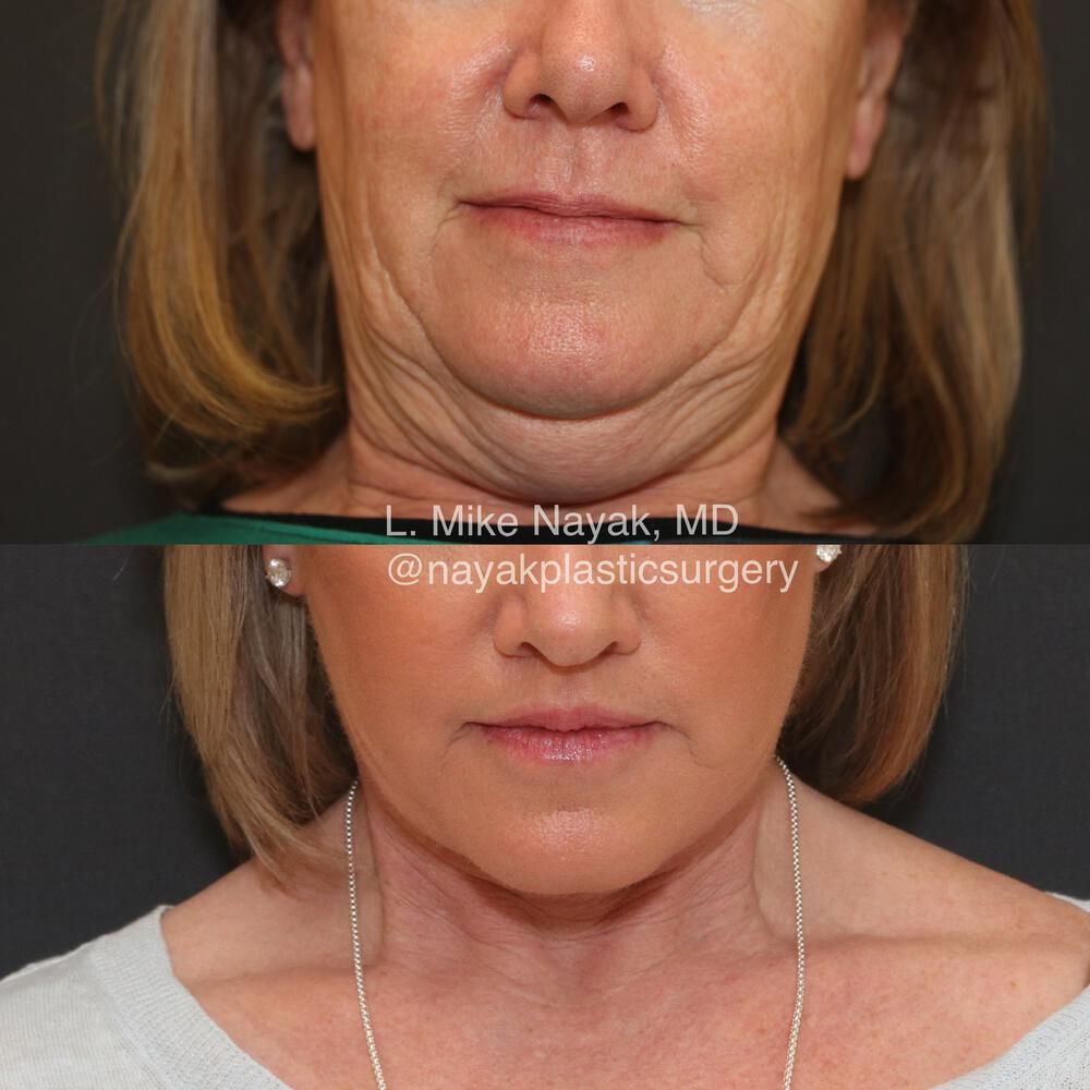 Lip Lift Before & After