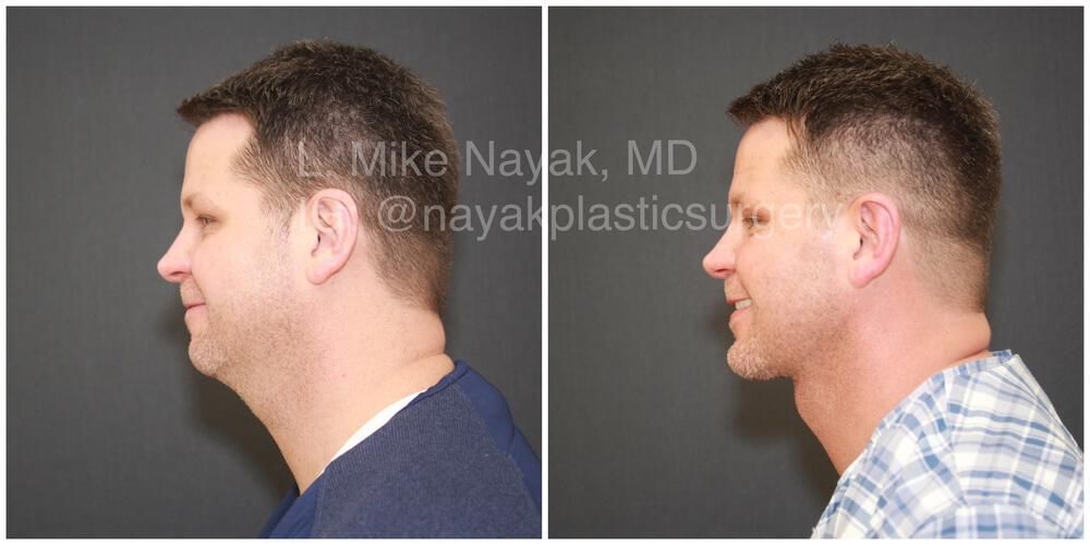 Deep Necklift Before & After