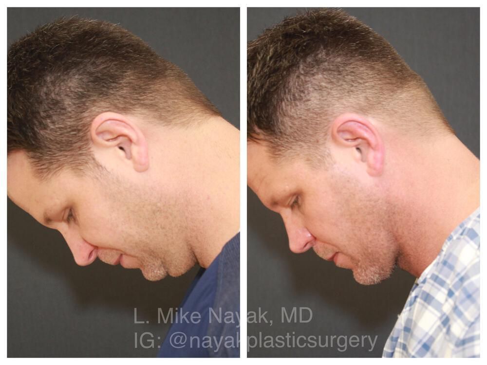 Deep Necklift Before & After