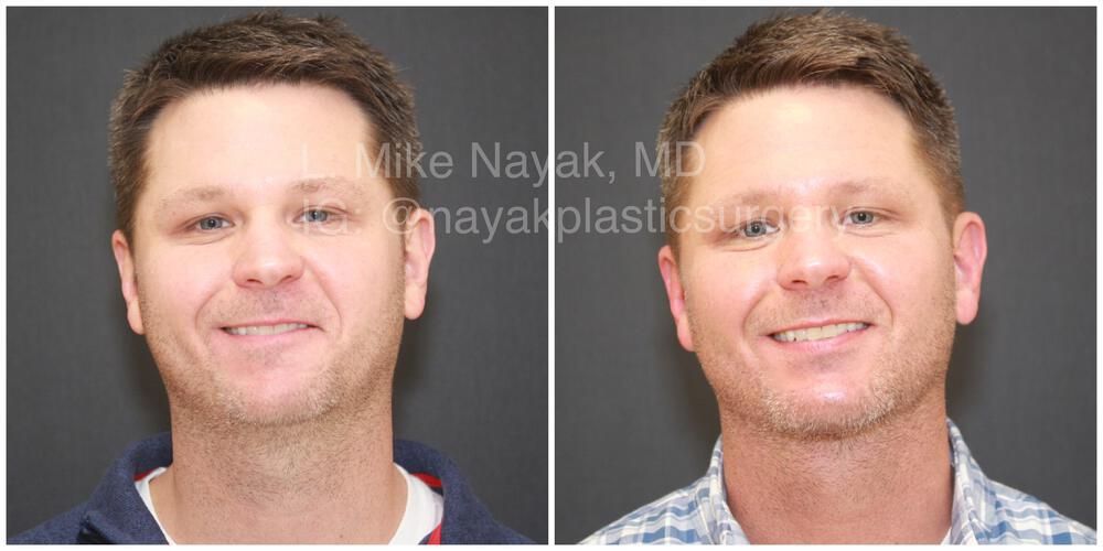 Deep Necklift Before & After