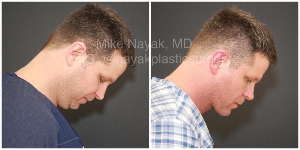 Deep Necklift Before & After