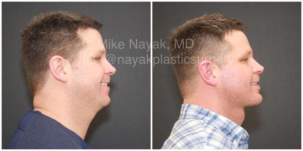 Deep Necklift Before & After