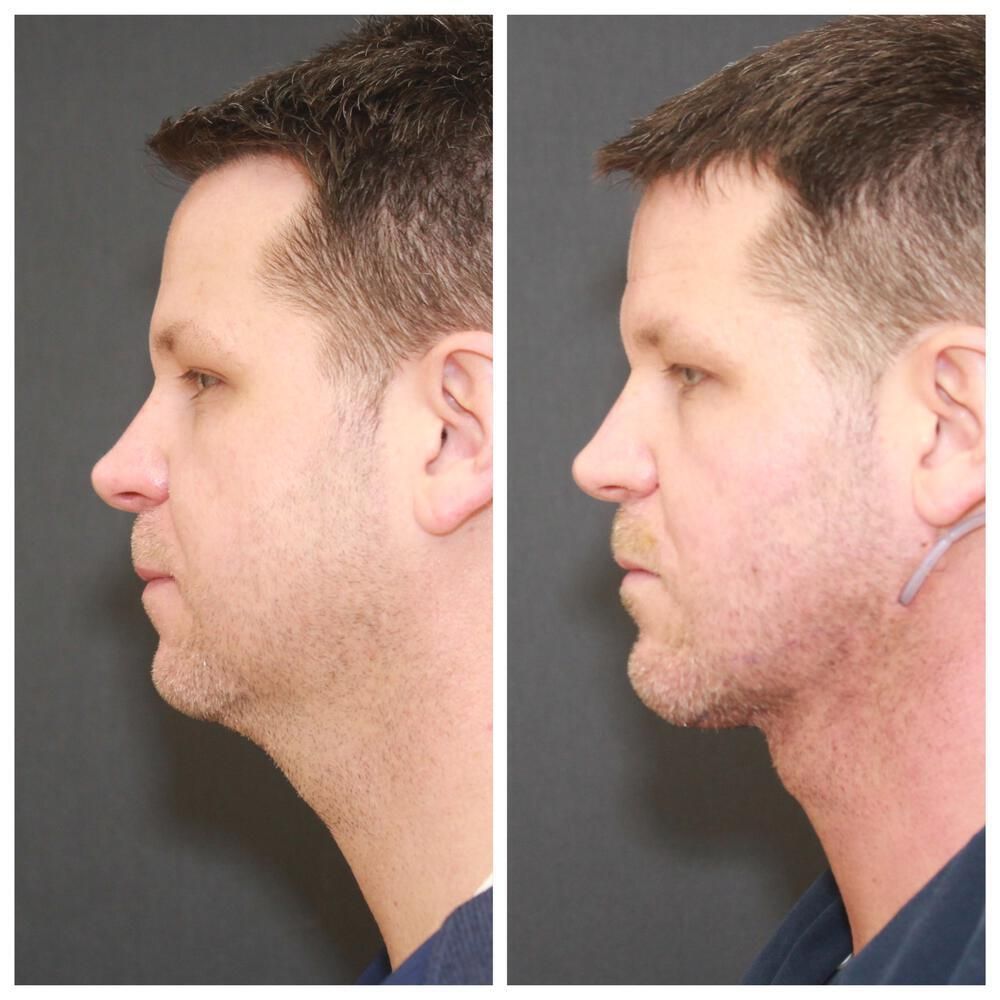 Deep Necklift Before & After