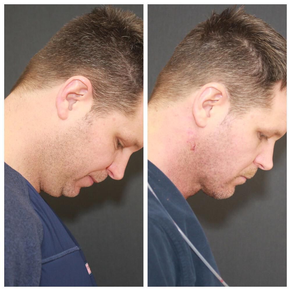 Deep Necklift Before & After